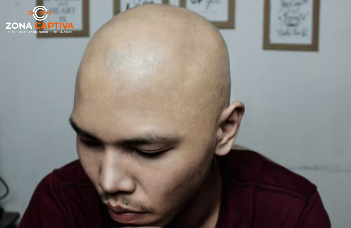 La calvicie podría aumentar el riesgo de cáncer de piel