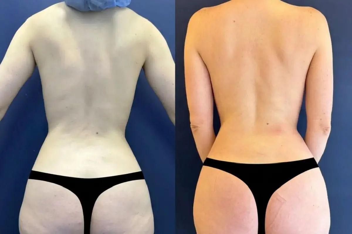 New Body presenta la campaña No Más Celulitis en Colombia